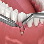 Best Gum Grafting clinic in Dubai UAE image